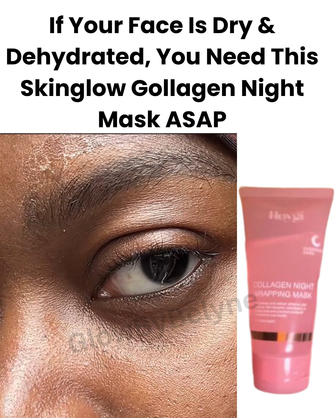 Dry and dehydrated skin around the eyes