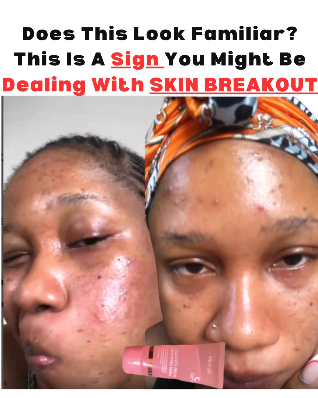 Skin breakout and uneven texture before treatment