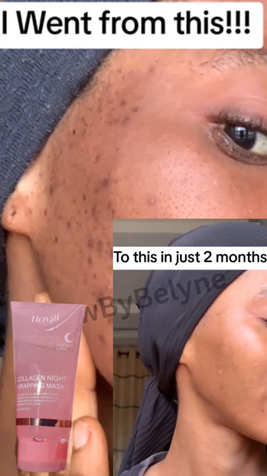 Before and after using the collagen night mask on breakouts