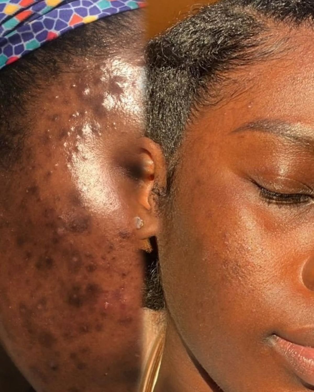 Before and after showing clearer skin